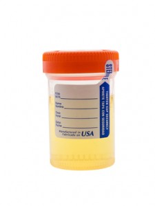 nkf-urine-test